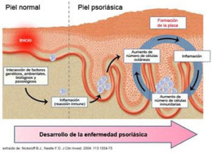 psoriasis - Madrid Acupuntura