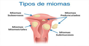 miomas - Madrid Acupuntura