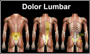 Acupuntura para le dolor lumbar