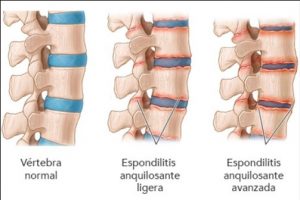 Madrid-Acupuntura-espondilosis