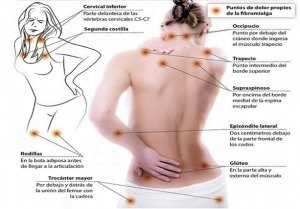 Madrid-Acupuntura-Fibromialgia