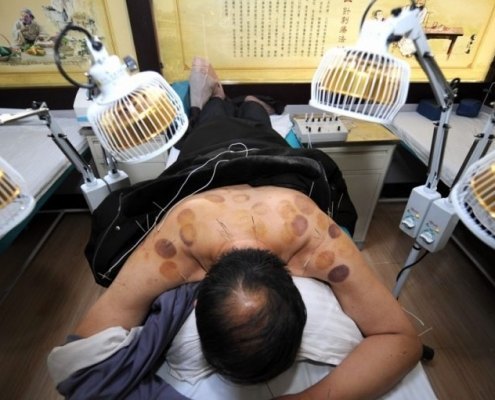 Un hombre recibe tratamiento de acupuntura en un hospital en Wuwei, provincia de Gansu, noroeste de China.