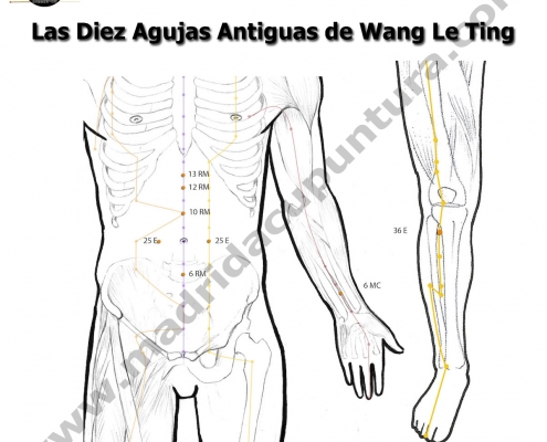 Las Diez Agujas Antiguas de Wang Le Ting
