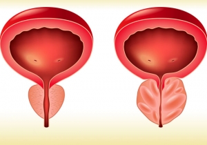 Madrid-Acupuntura-prostatitis