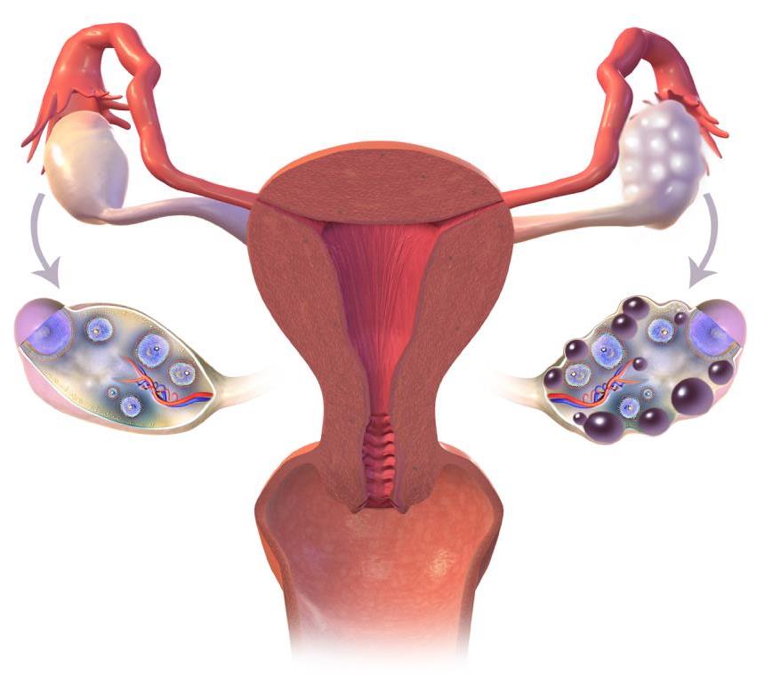 Ovario poliquístico