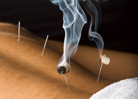 moxibustion-madrid-acupuntura