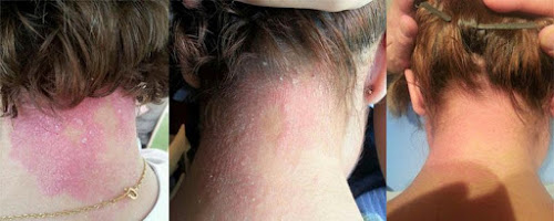 Psoriasis caso real en Madrid Acupuntura